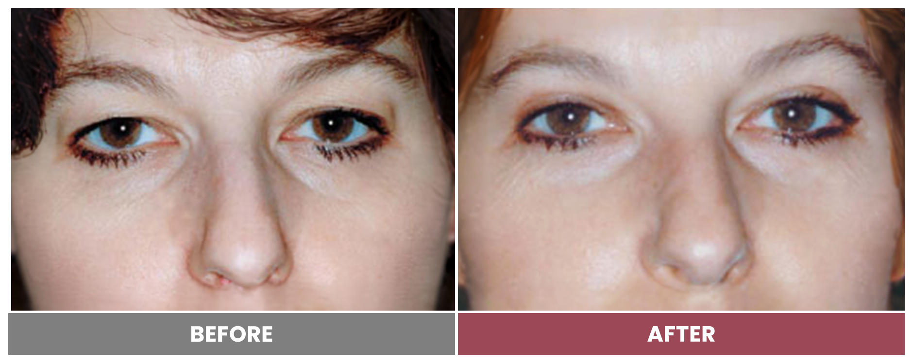 Upper Blepharoplasty - Case 73